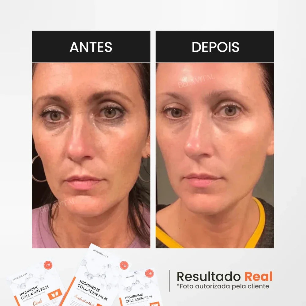 MÁSCARA DE COLÁGENO + ACIDO HIALURÔNICO + ATIVO DO BOTOX - GOLDBOTOX