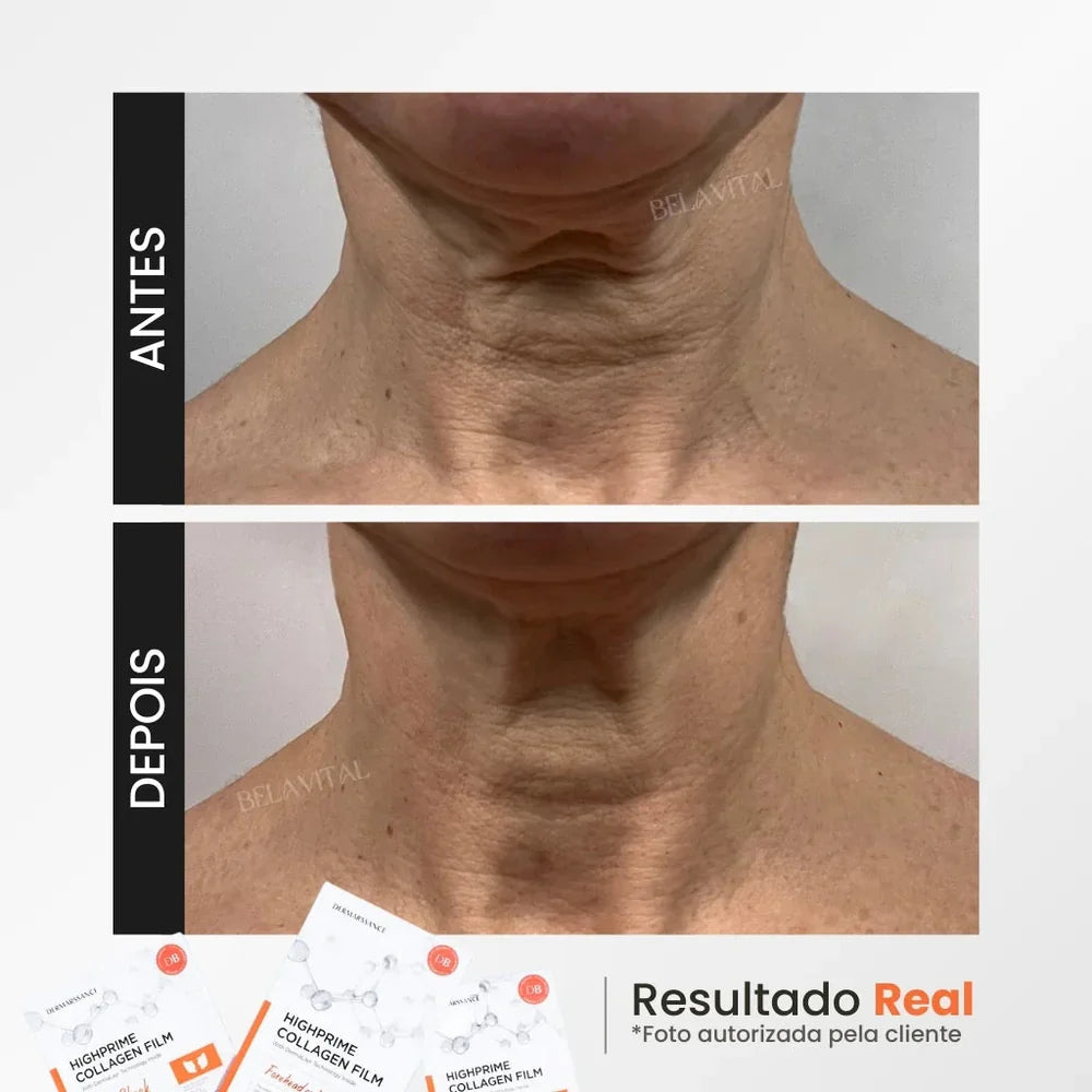 MÁSCARA DE COLÁGENO + ACIDO HIALURÔNICO + ATIVO DO BOTOX - GOLDBOTOX